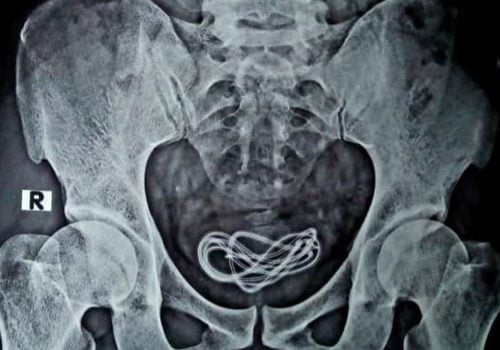 जब मोबाइल फोन चार्ज गर्ने ‘चार्जर केबल’ मानिसको मूत्रथैली भित्र भेटियो !