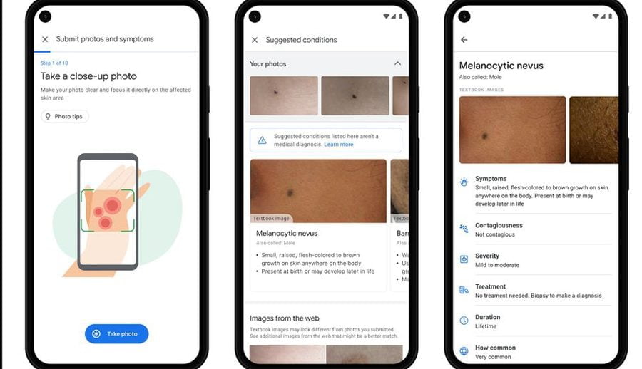 गुगलको एआई टूलले बिरामीको चर्म रोग पत्ता लगाउन सघाउ पुर्याउने
