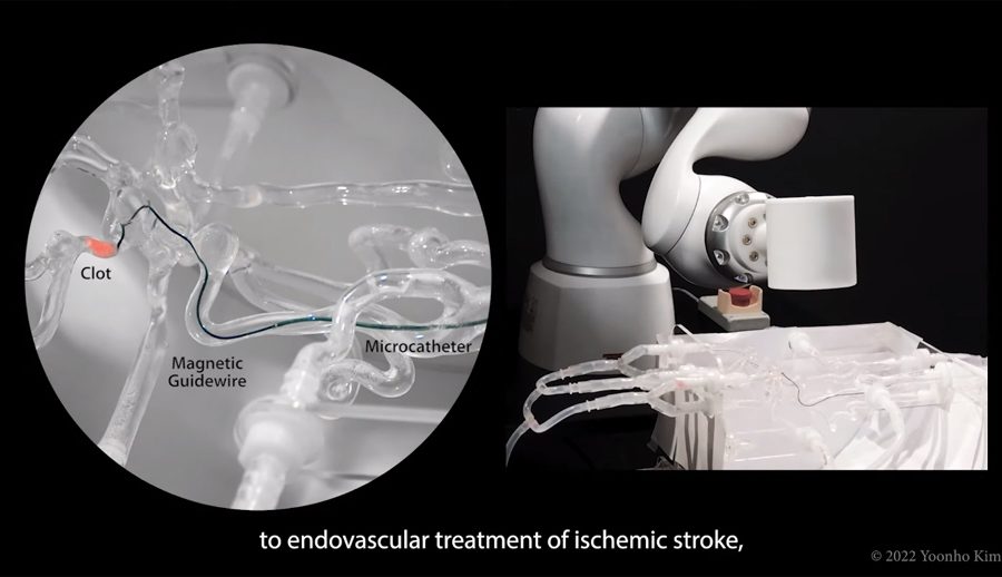 एमआईटी इन्जिनीयरहरुद्वारा इमर्जेन्सी स्ट्रोक सर्जरीमा सघाउने रोबोटिक पाखुरा निर्माण