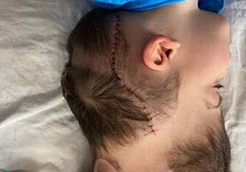 भर्चुअल रियालिटीको सहयोगमा जोडिएका जुम्ल्याहा छुट्टाइयो