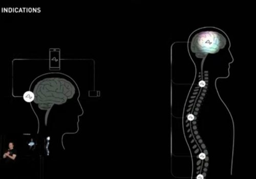 इलन मस्कको न्यूरालिंकले बनाएको वायरलेस ब्रेन चिप ६ महिना भित्र मानवमा परीक्षण गरिने