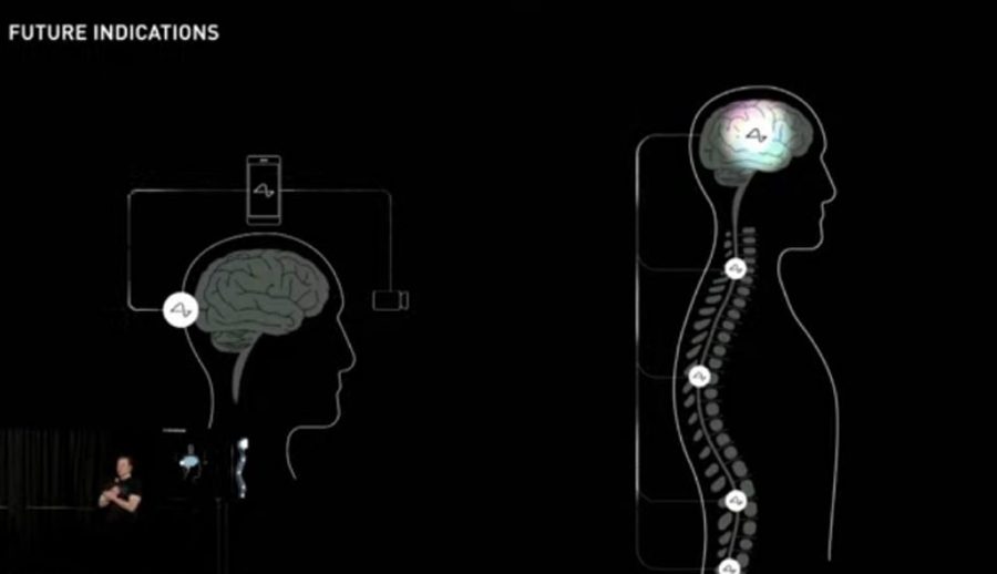इलन मस्कको न्यूरालिंकले बनाएको वायरलेस ब्रेन चिप ६ महिना भित्र मानवमा परीक्षण गरिने